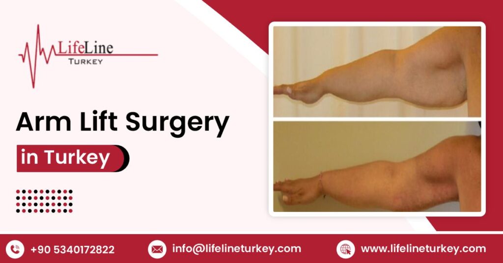 arm lift surgery