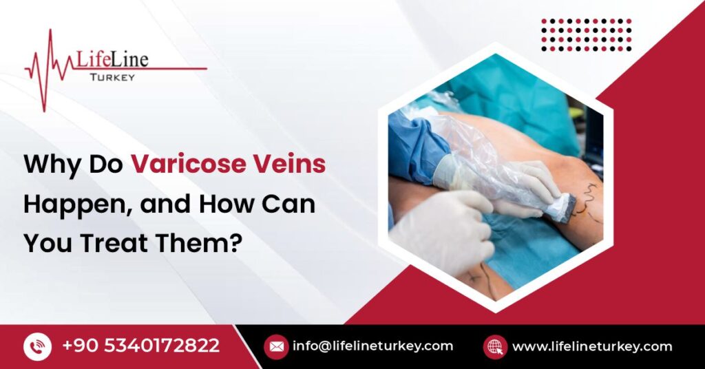 varicose vein treatments